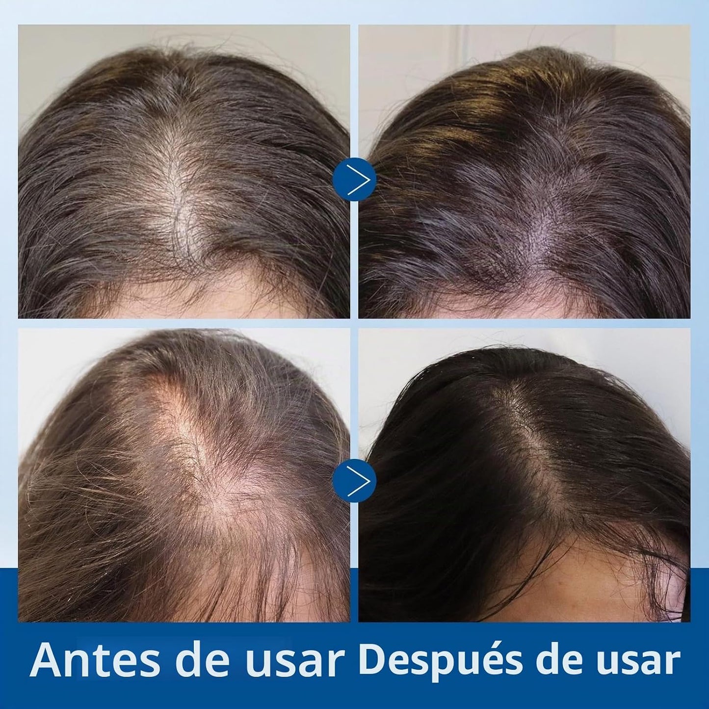 SÉRUM CAPILAR CON ROLLER PARA EL CRECIMIENTO DEL CABELLO